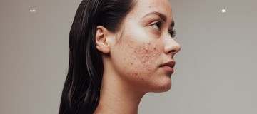 "Acne Ingredients" That Make Your Acne Worse