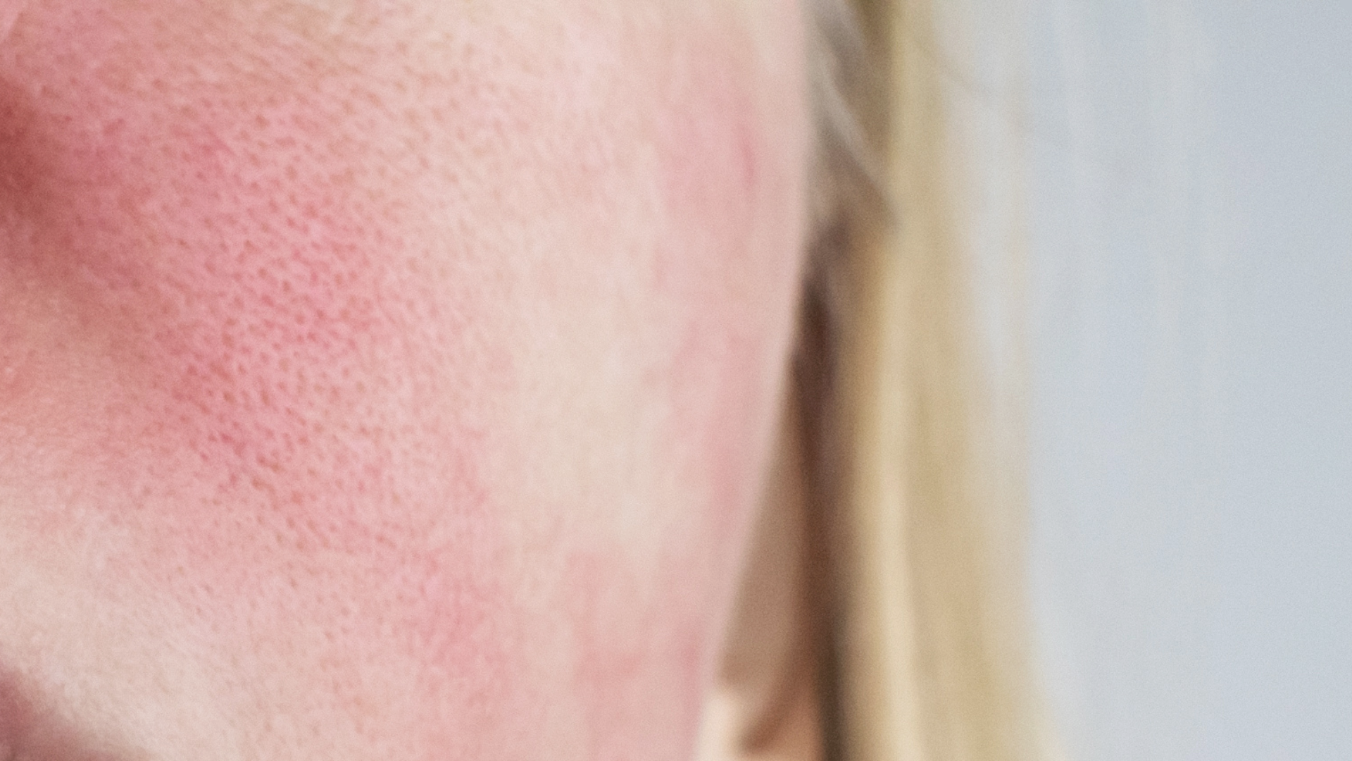 Understanding Rosacea Through the Skin Microbiome